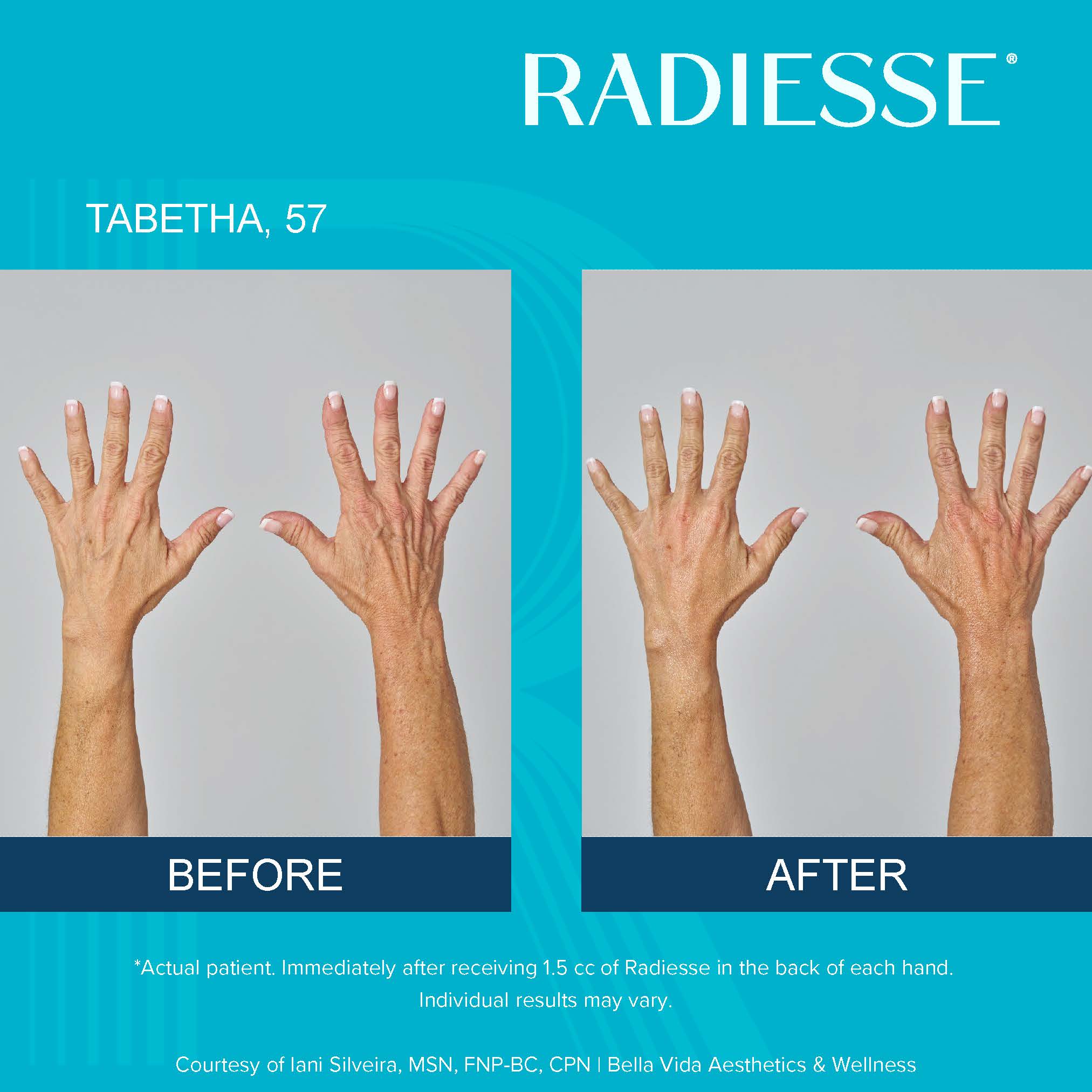 Radiesse hand rejuvenation results at Chicago Skin Clinic in Chicago, Illinois