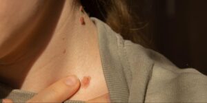 Skin Cancer Awareness Month is Coming: How to Perform a Skin Self-Check