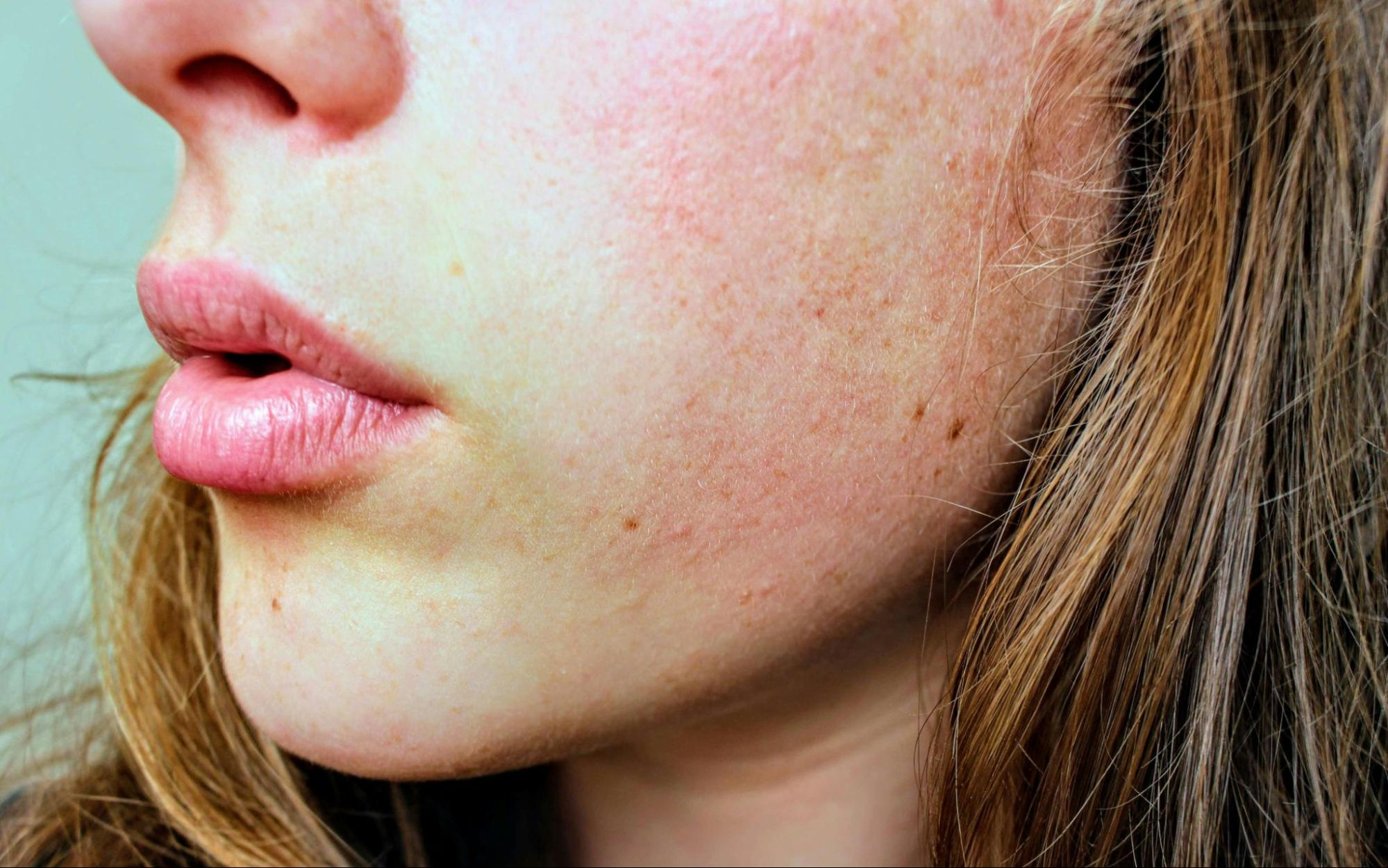 Patient with facial redness receiving care from a rosacea specialist in Chicago