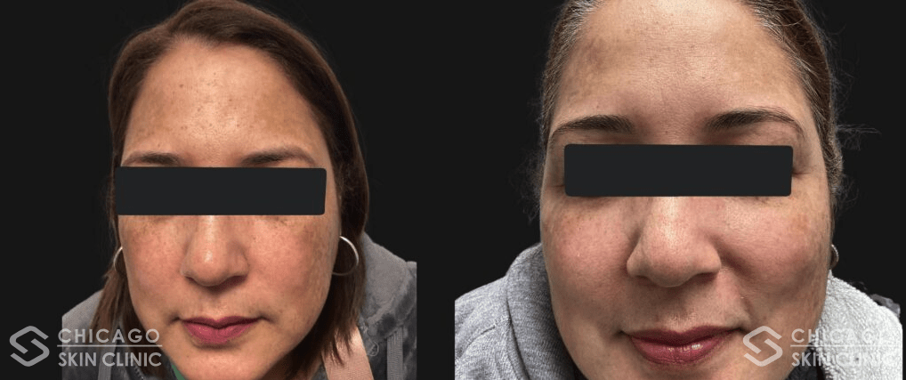 Patient getting Melasma treatment in Chicago.
