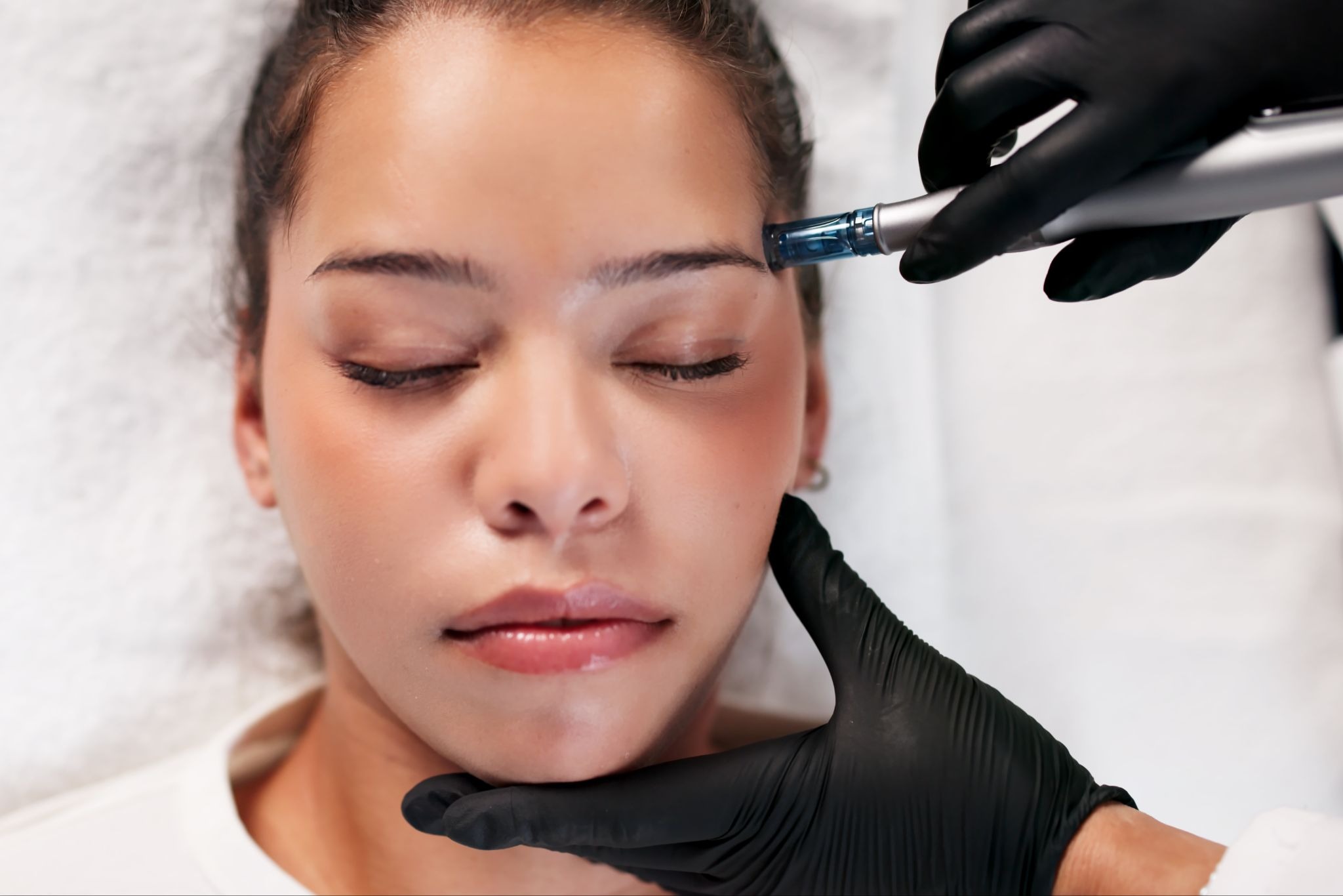 Is Microneedling Right for You? A Chicago Skin Expert Explains