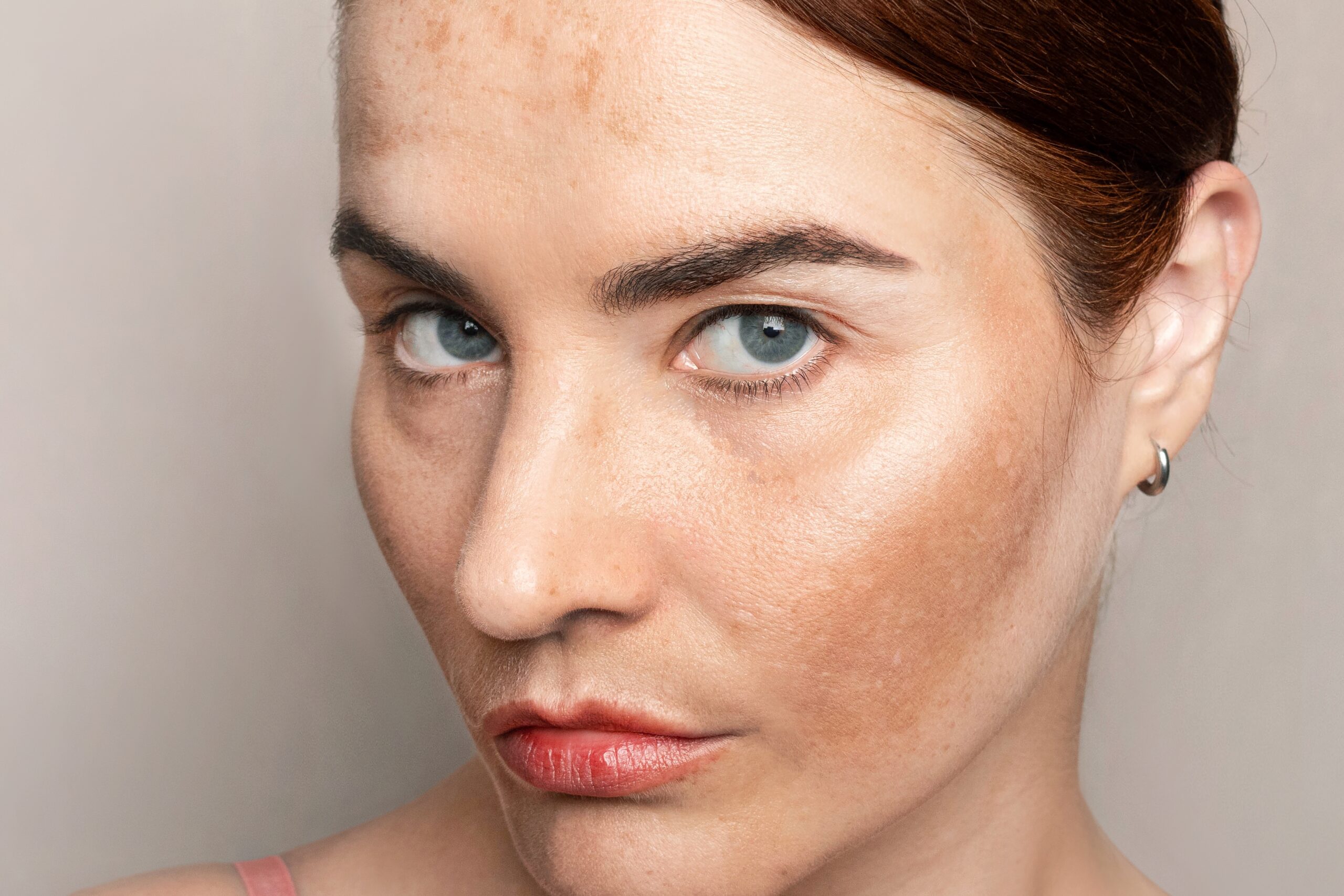 Close-up of patient skin during melasma treatment consultation in Chicago