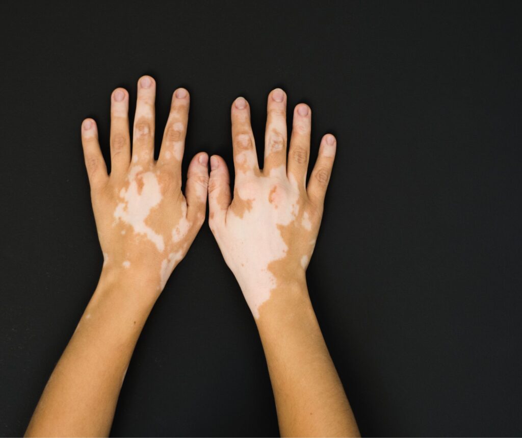 Hands showing white depigmented patches caused by vitiligo before treatment